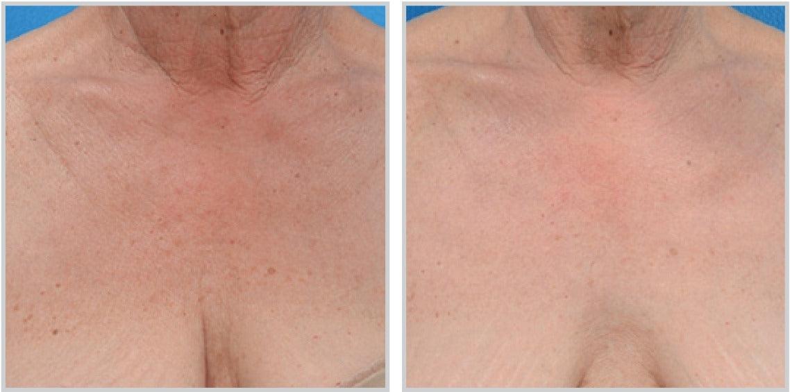 BroadBand Light (BBL) - Livinz Medspa