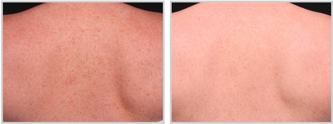 BroadBand Light (BBL) - Livinz Medspa