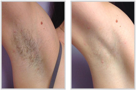Laser Hair Removal - Livinz Medspa