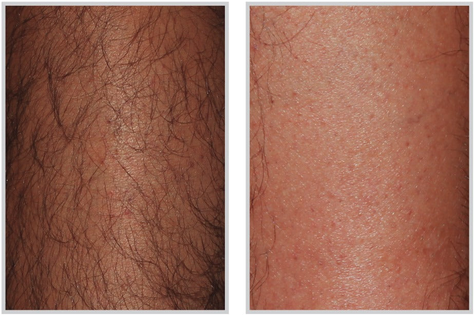 Laser Hair Removal