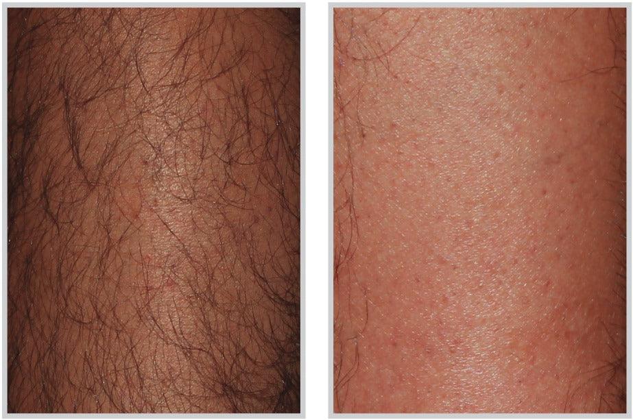 Laser Hair Removal - Livinz Medspa