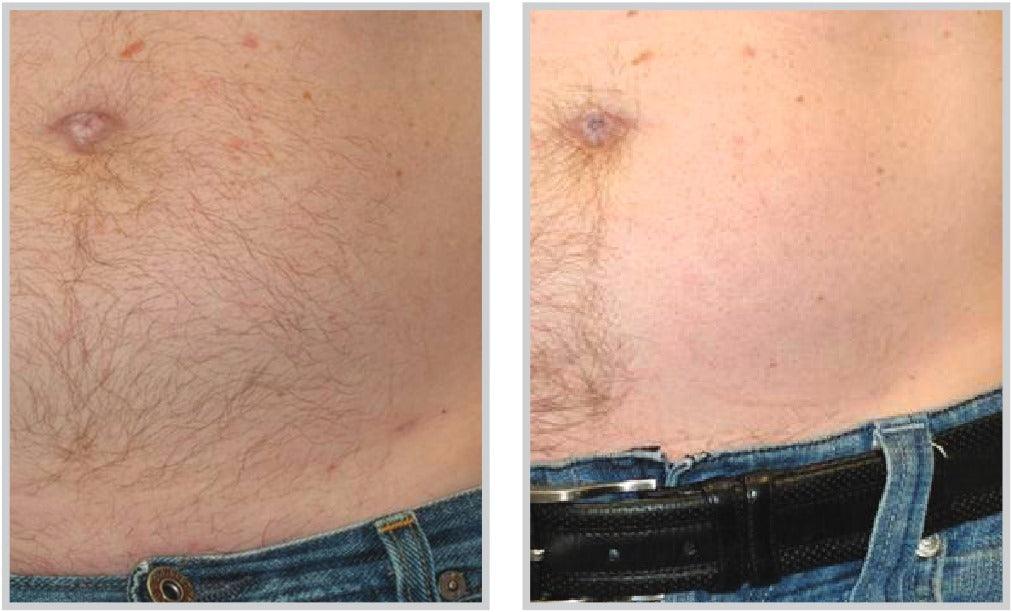 Laser Hair Removal - Livinz Medspa