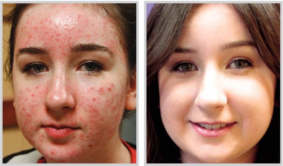 Forever Clear BBL™ - Livinz Medspa