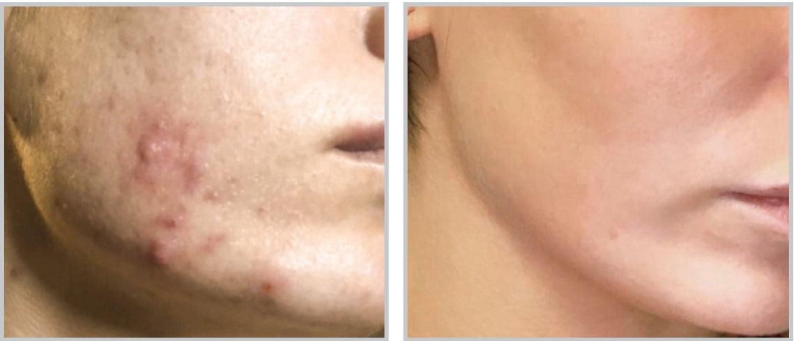 Forever Clear BBL™ - Livinz Medspa