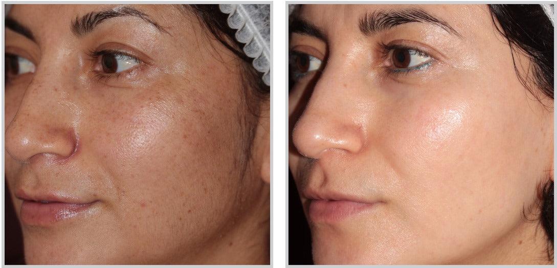 Forever Body BBL™ - Livinz Medspa