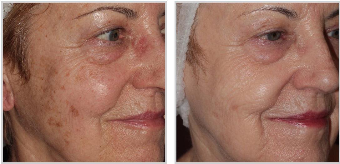 Forever Body BBL™ - Livinz Medspa