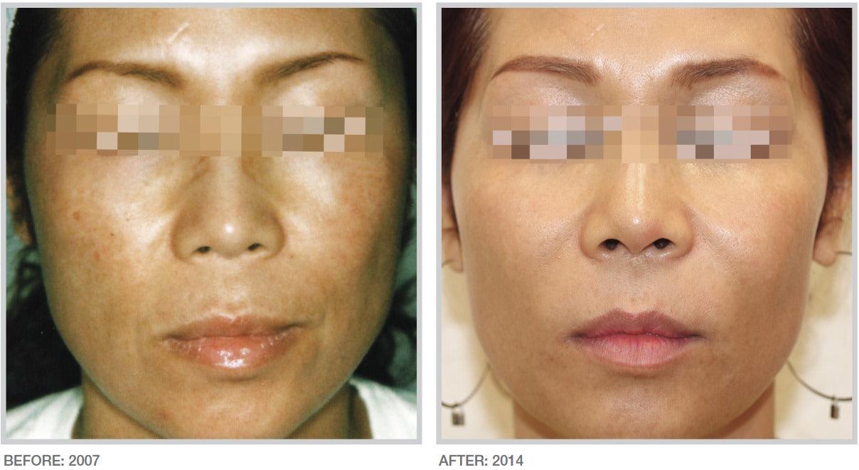 Forever Body BBL™ - Livinz Medspa