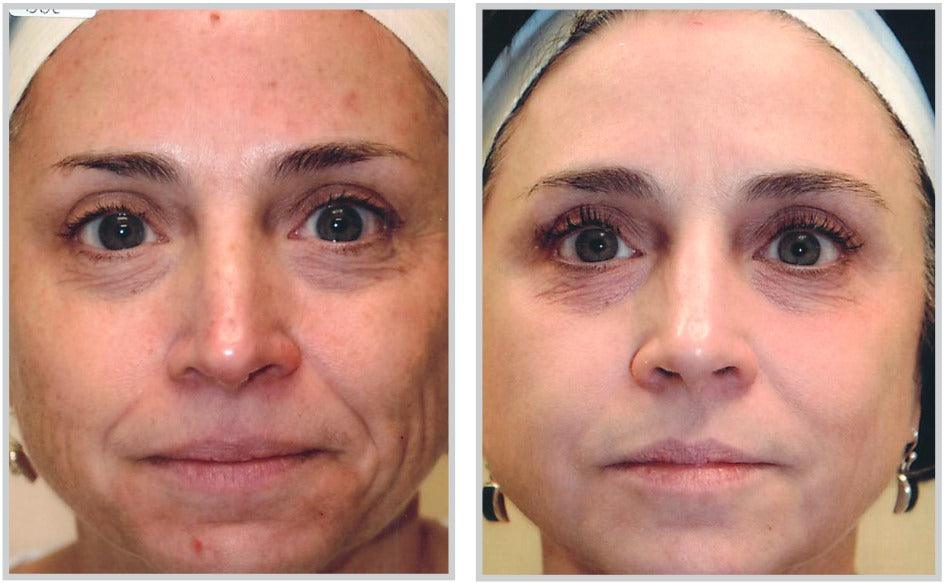Forever Body BBL™ - Livinz Medspa