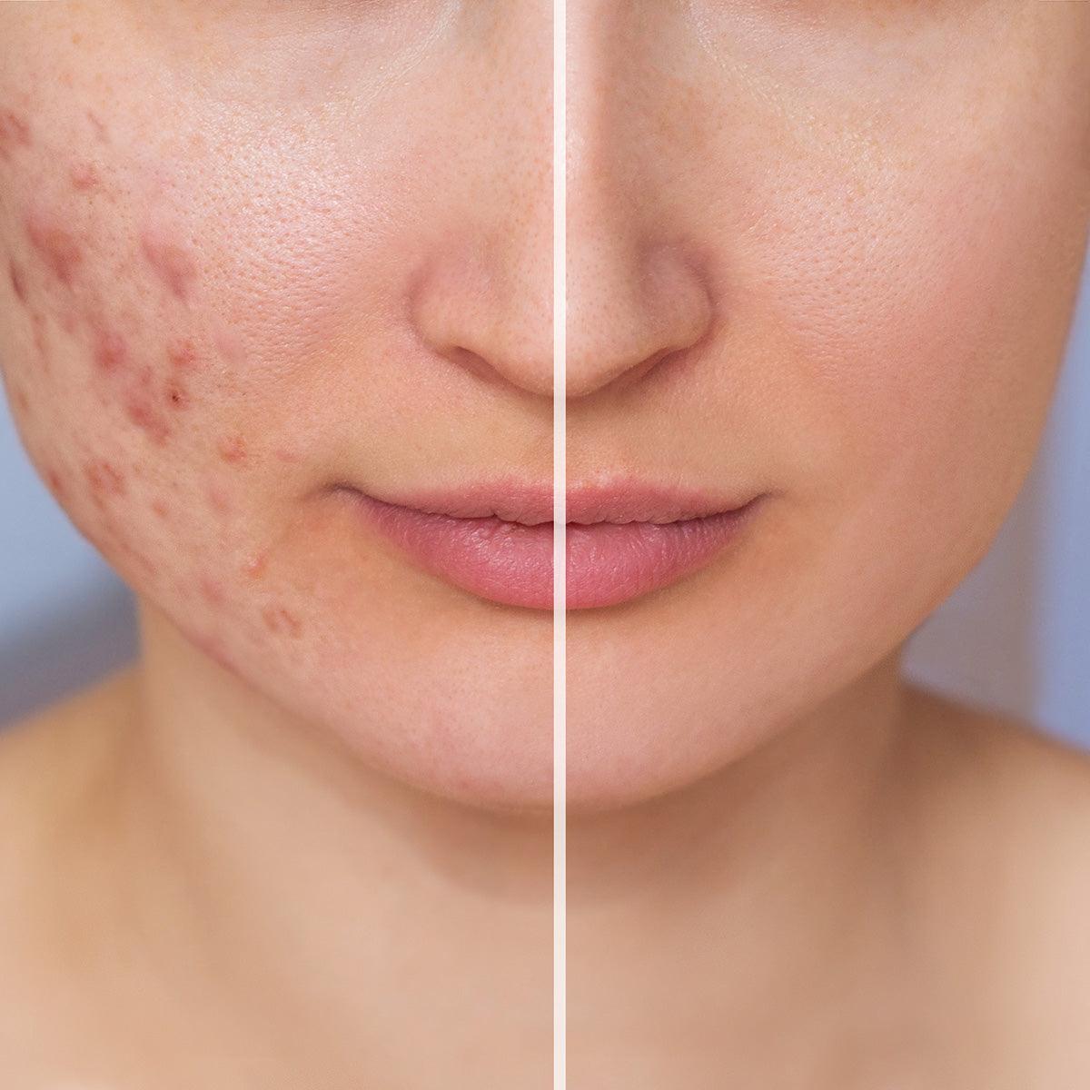Acne Scars - Livinz Medspa