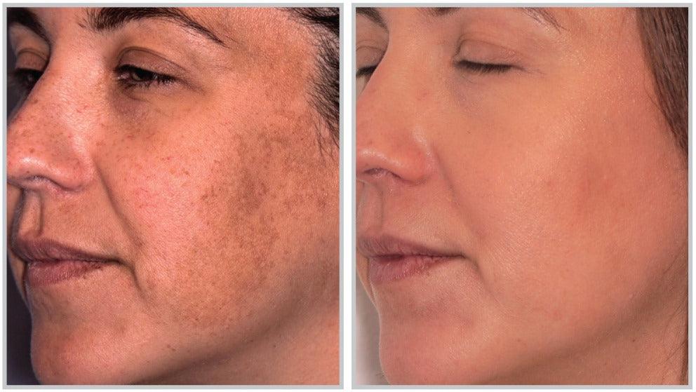 Sciton MOXI™ - Livinz Medspa