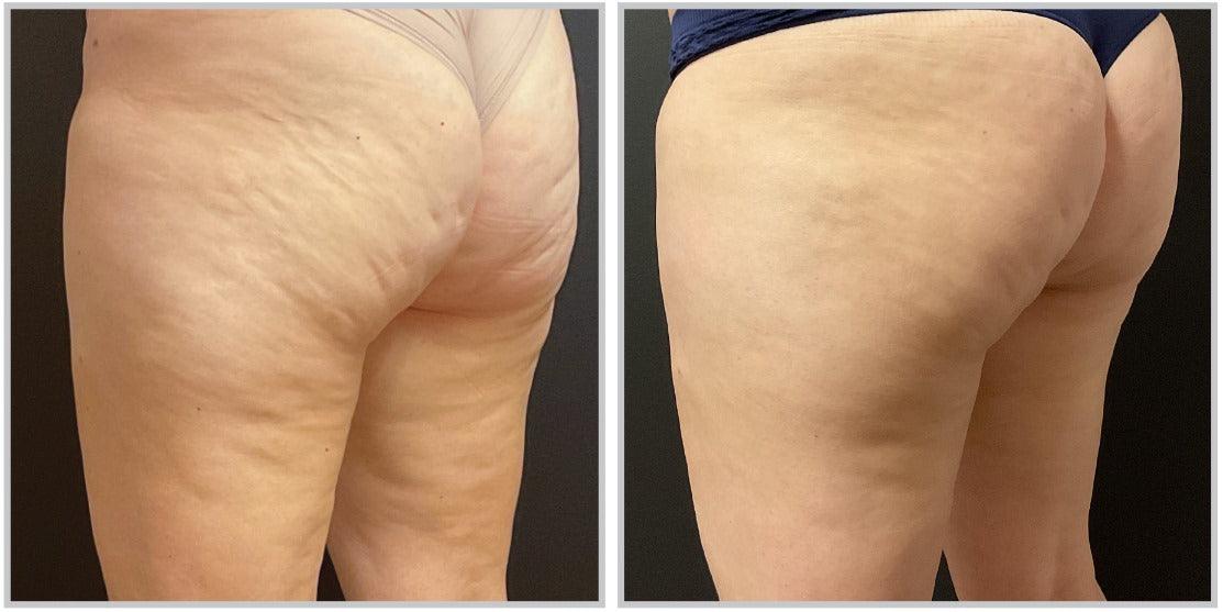 Sciton MOXI™ - Livinz Medspa