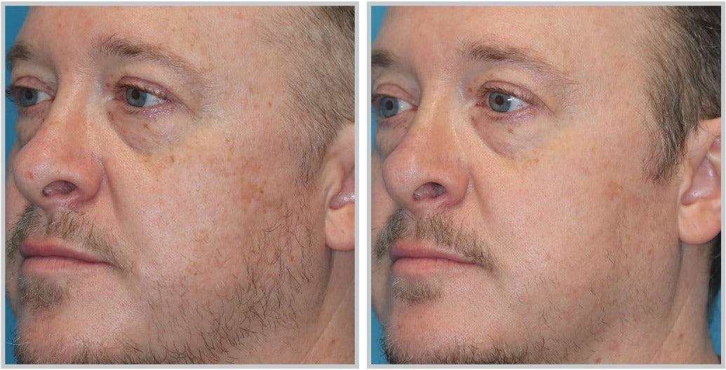 Sciton MOXI™ - Livinz Medspa