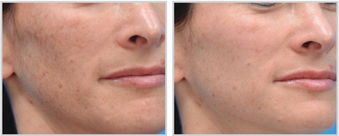Sciton MOXI™ - Livinz Medspa