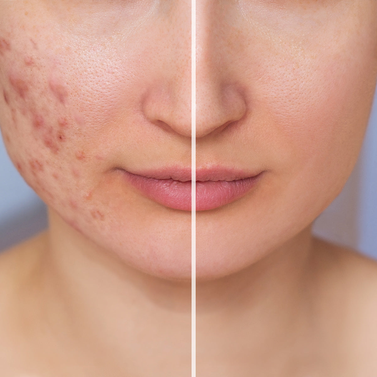 Acne Scars